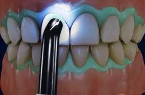 冷光美白会导致牙齿酸痛敏感，这是真的吗？-6.jpg