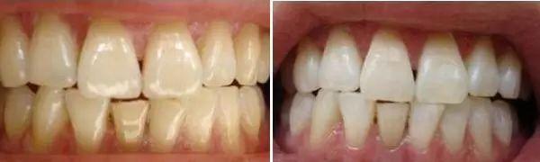 冷光美白会导致牙齿酸痛敏感，这是真的吗？-7.jpg