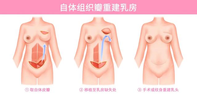 一个让女性拾回自信的技术——乳房重建术-5.jpg