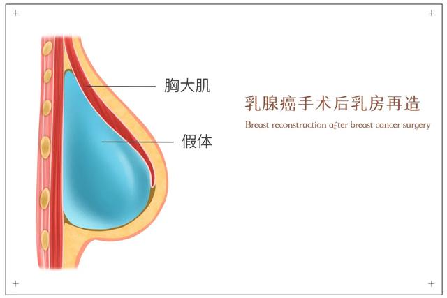 一个让女性拾回自信的技术——乳房重建术-6.jpg